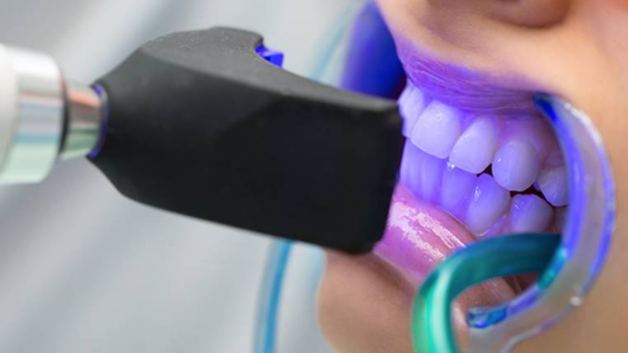 Diş Beyazlatmanın Sağlık ve Estetik Faydaları