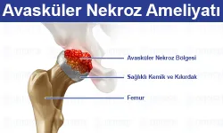 Avasküler Nekroz: Belirtileri, Tedavisi ve Yaşam Üzerindeki Etkileri