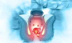 Anal Fissür (Makat Çatlağı): Utanılan Ama Konuşulması Gereken Bir Sorun