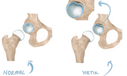 Kalça Labrum Yırtığı: Belirtiler, Tedavi Seçenekleri ve İyileşme Süreci