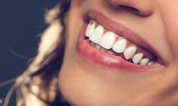 Hollywood Smile Uygulaması Nasıl Planlanır?