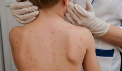 Alerjik hastalıklar nasıl kontrol altına alınabiliyor?