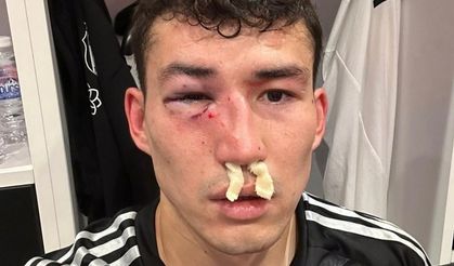 Beşiktaş: "Zaynutdinov’un burnunda ve göz çukurunda kırık saptanmıştır"