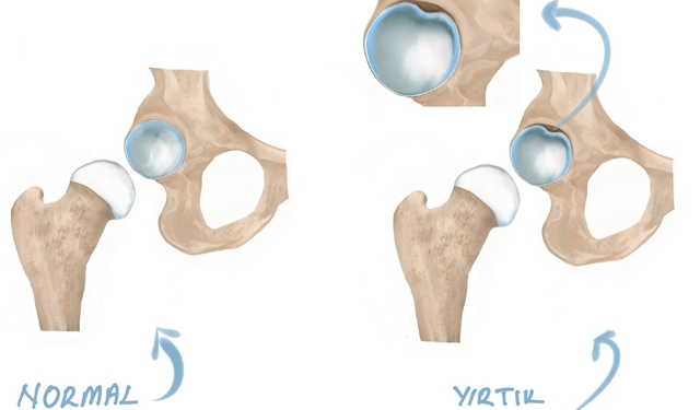 Kalça Labrum Yırtığı: Belirtiler, Tedavi Seçenekleri ve İyileşme Süreci
