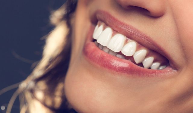 Hollywood Smile Uygulaması Nasıl Planlanır?