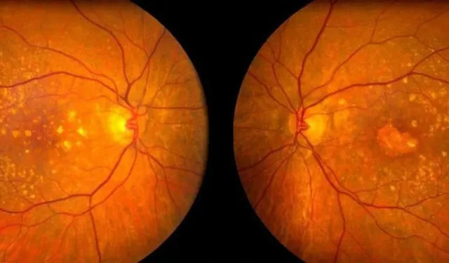 Sarı Nokta Hastalığı, Akıllı Lens ve Katarakt Ameliyatı Hakkında Merak Edilenler